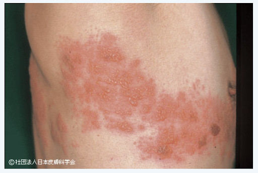 帯状疱疹を予防することはできるのでしょうか？